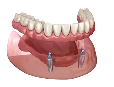 Implant Supported Dentures