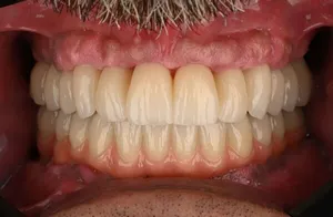 Before dental implants