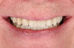 Before dental implants