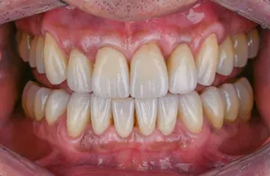 Before dental implants