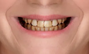After dental implants